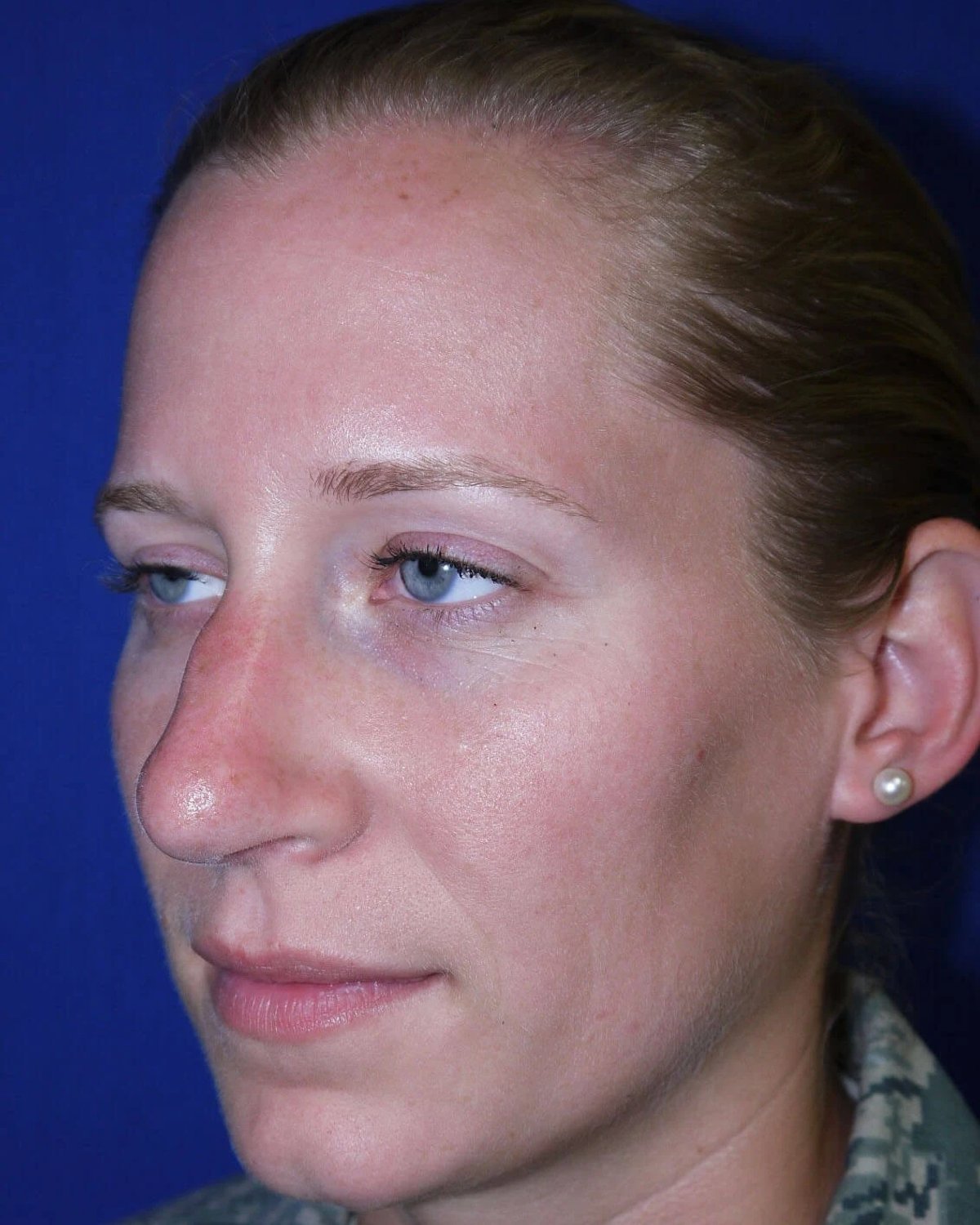 Rhinoplasty — Oblique Right view, after