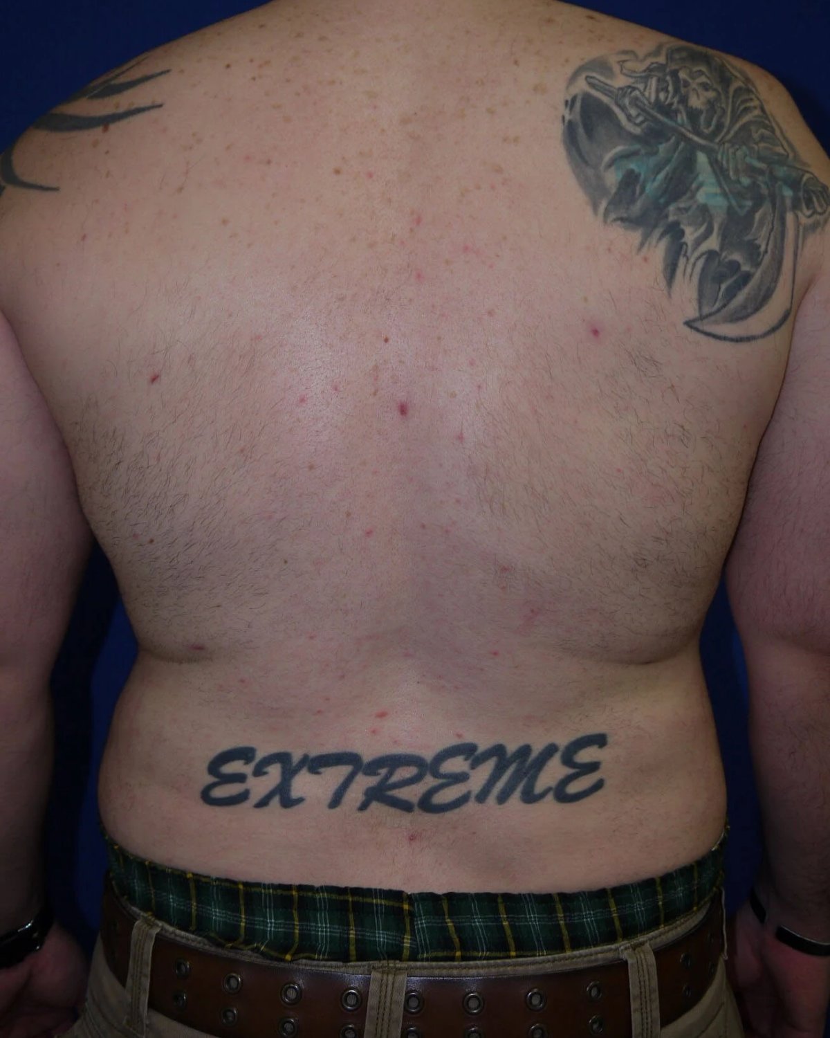 Tummy Tuck — Back view, after