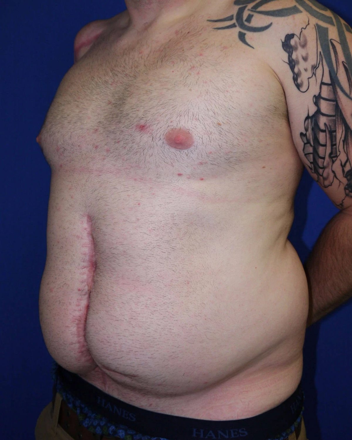 Tummy Tuck before