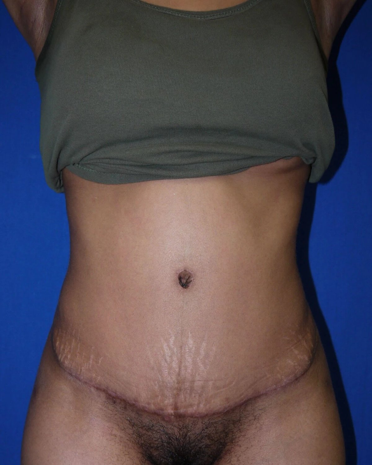 Tummy Tuck after