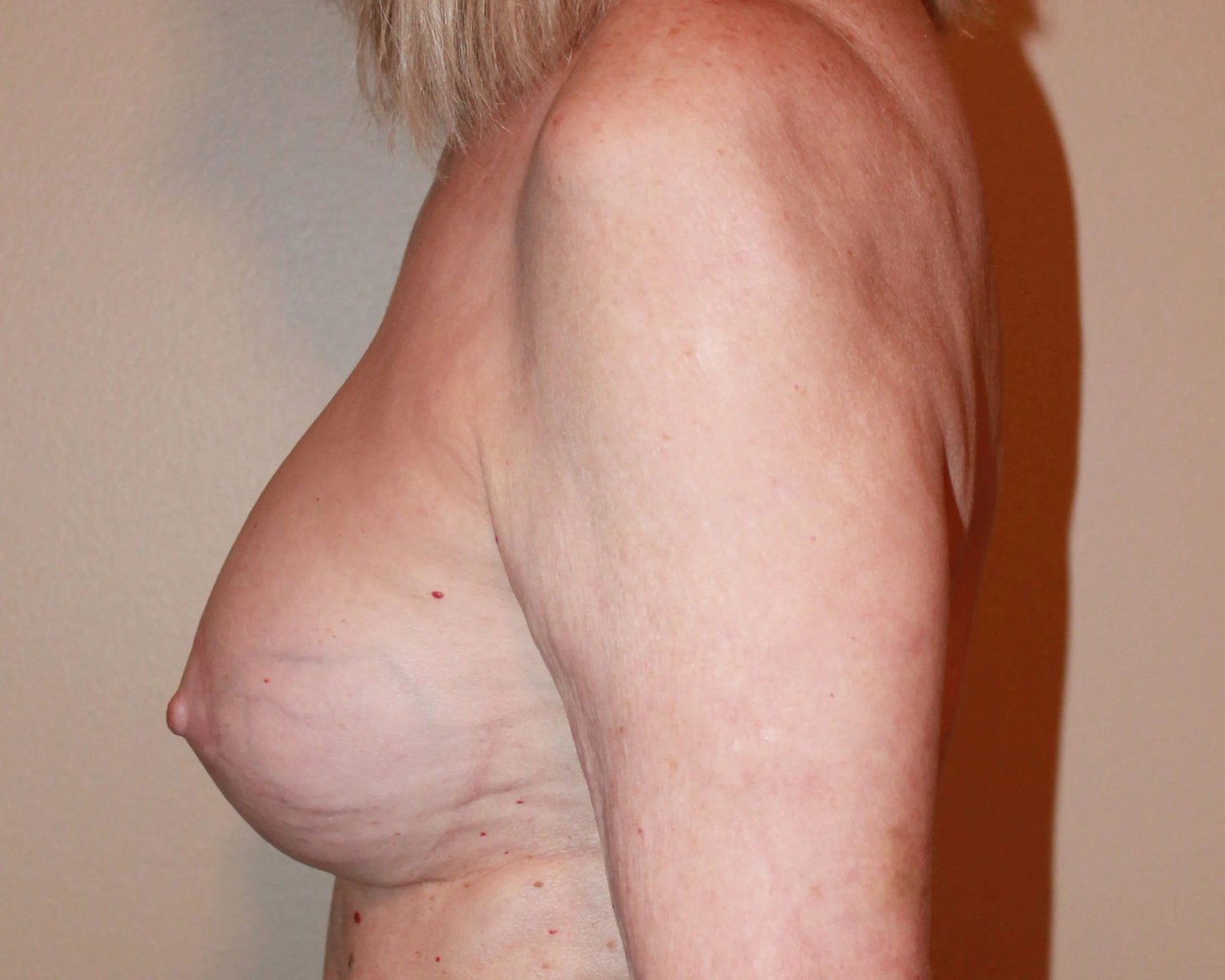 Breast Augmentation with Implants after