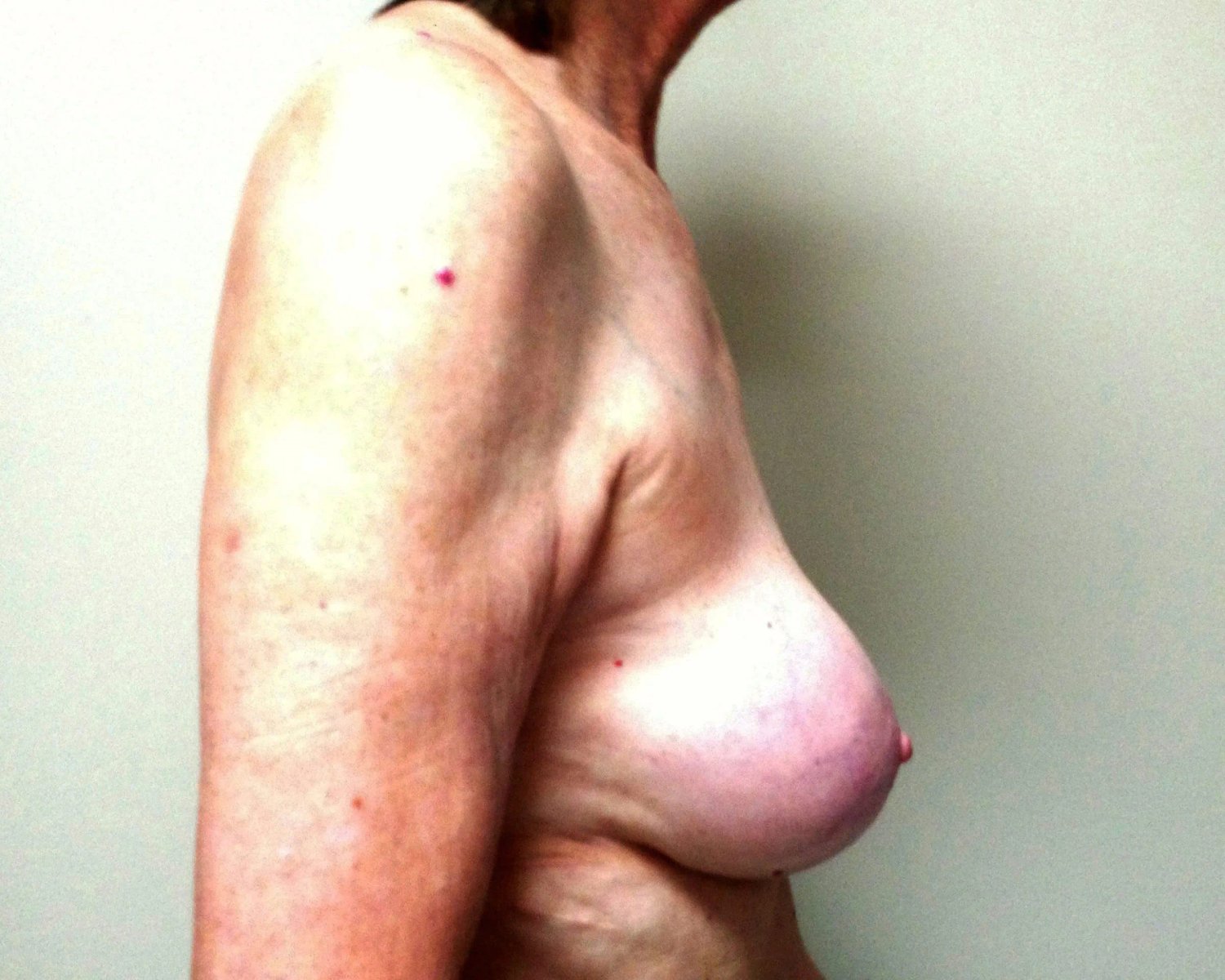 Breast Augmentation with Implants — Right Profile view, before