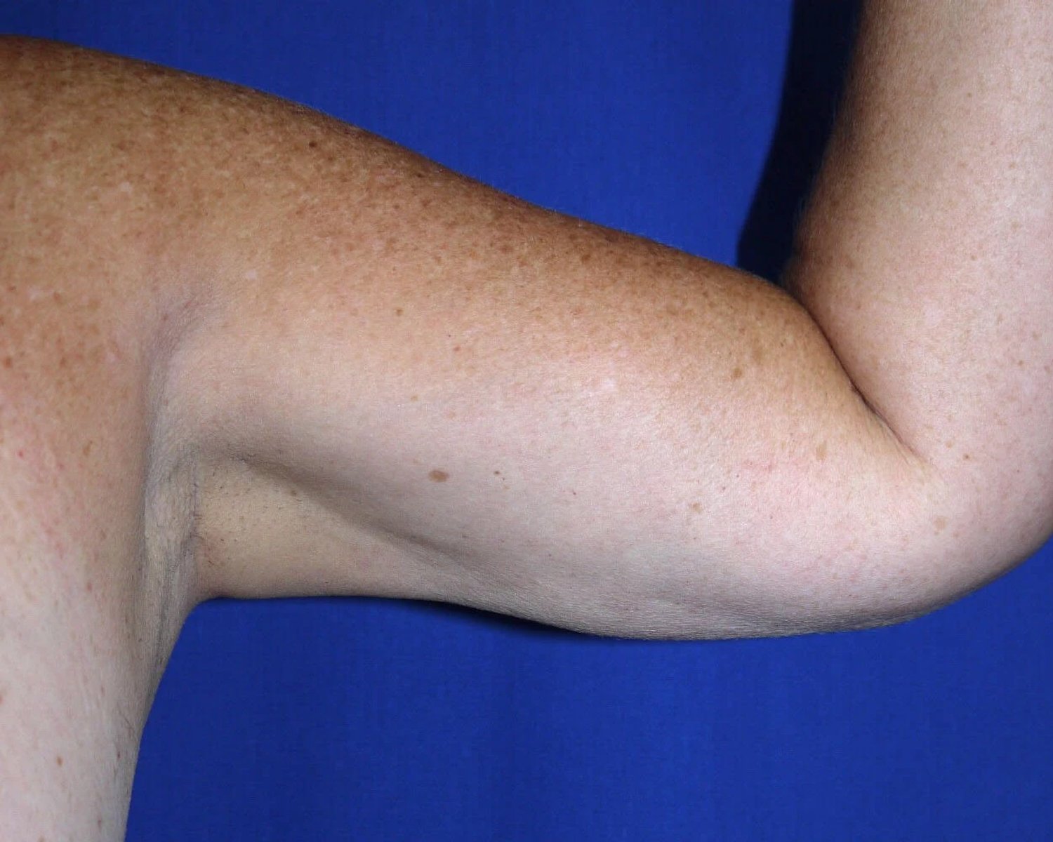 Arm Lift — Oblique Left view, after