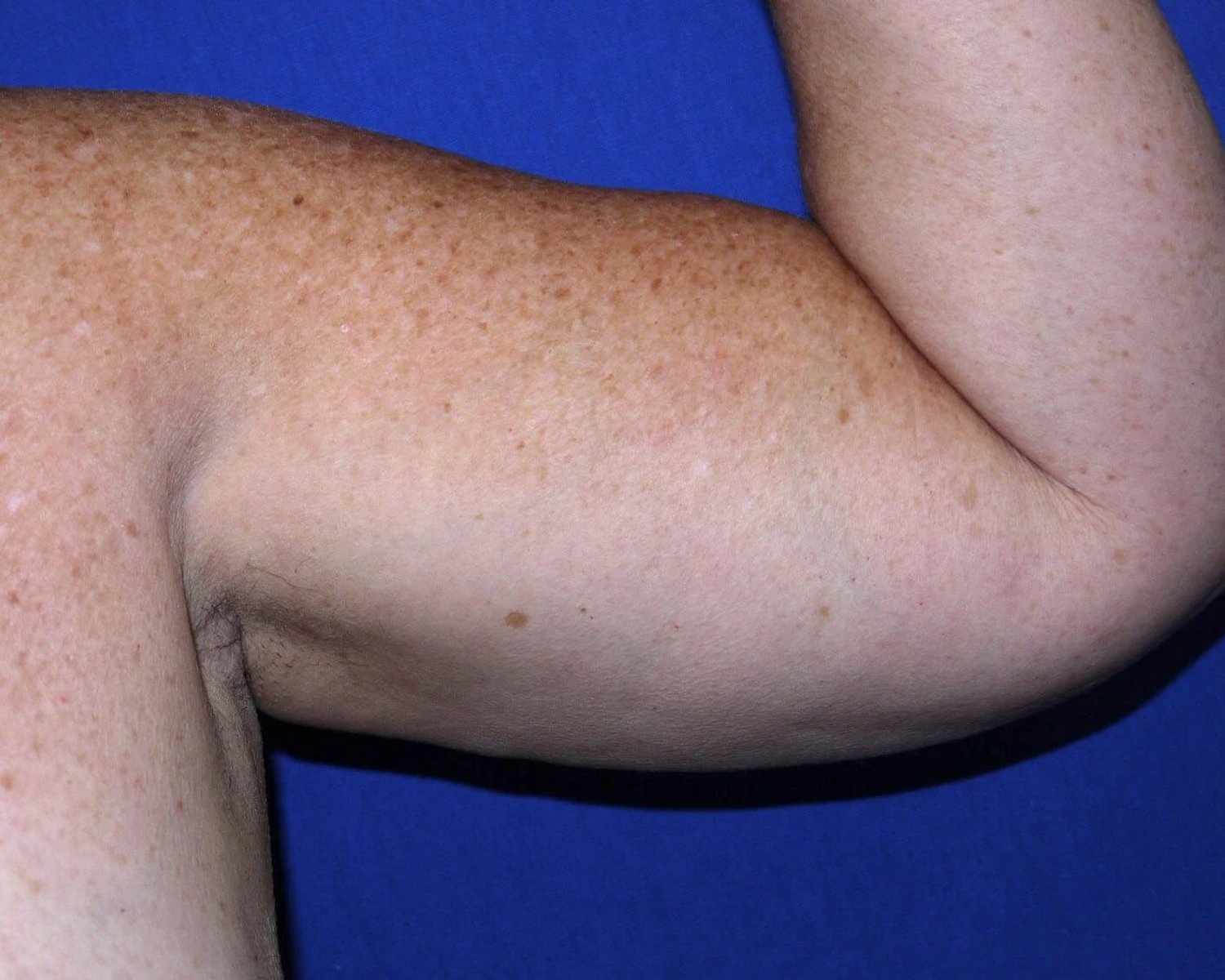 Arm Lift — Oblique Left view, before