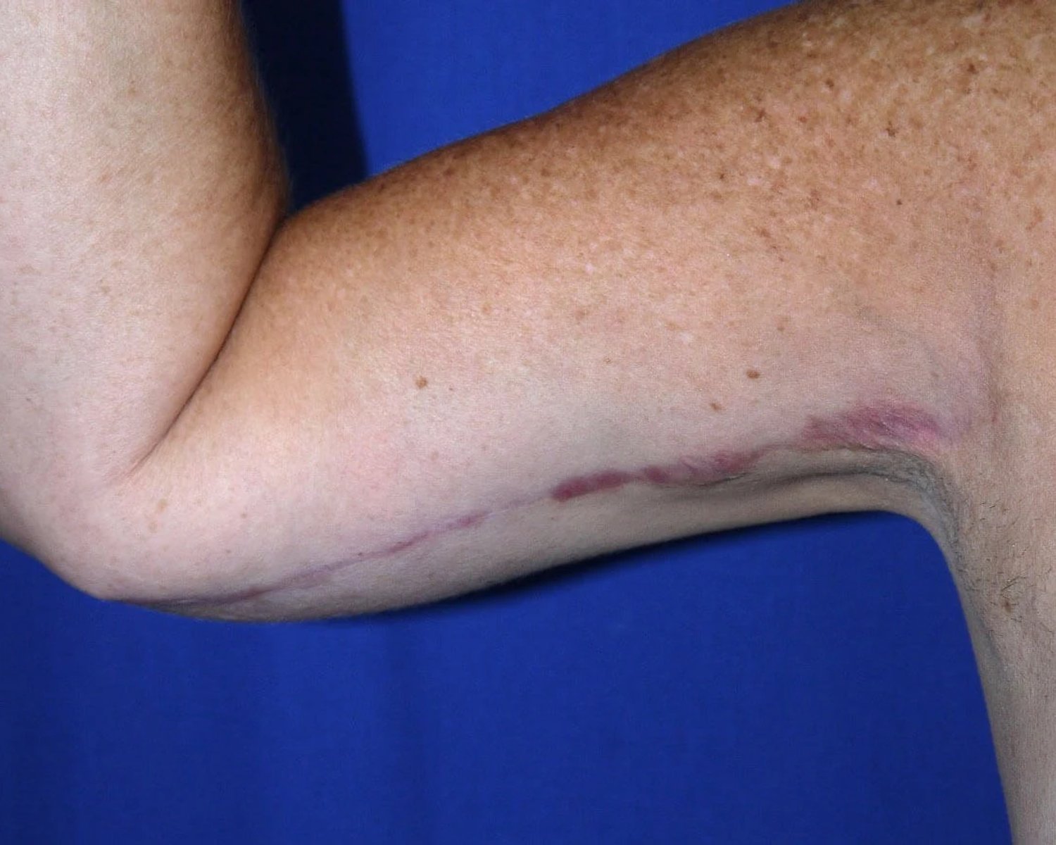 Arm Lift — Oblique Right view, after