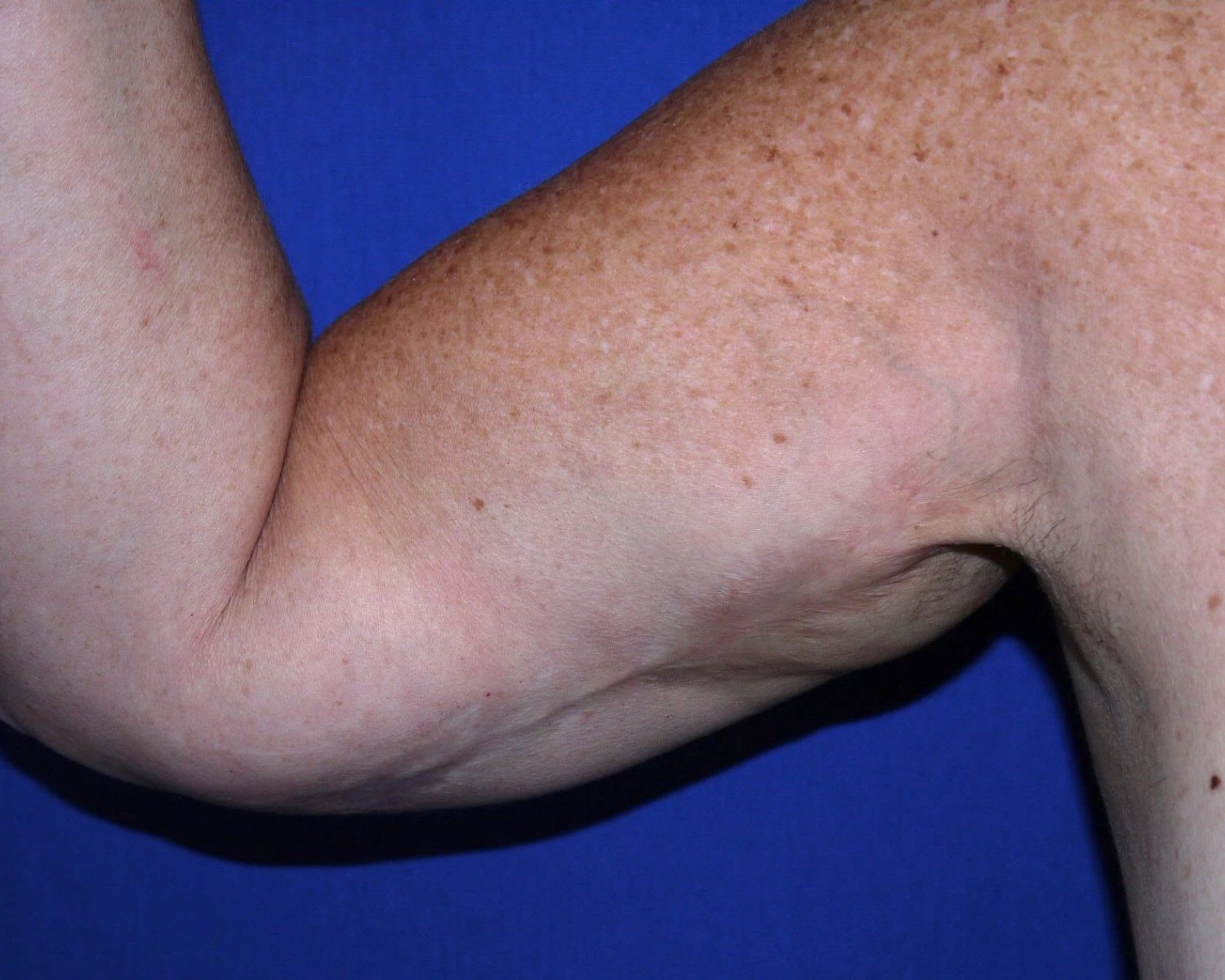 Arm Lift — Oblique Right view, before