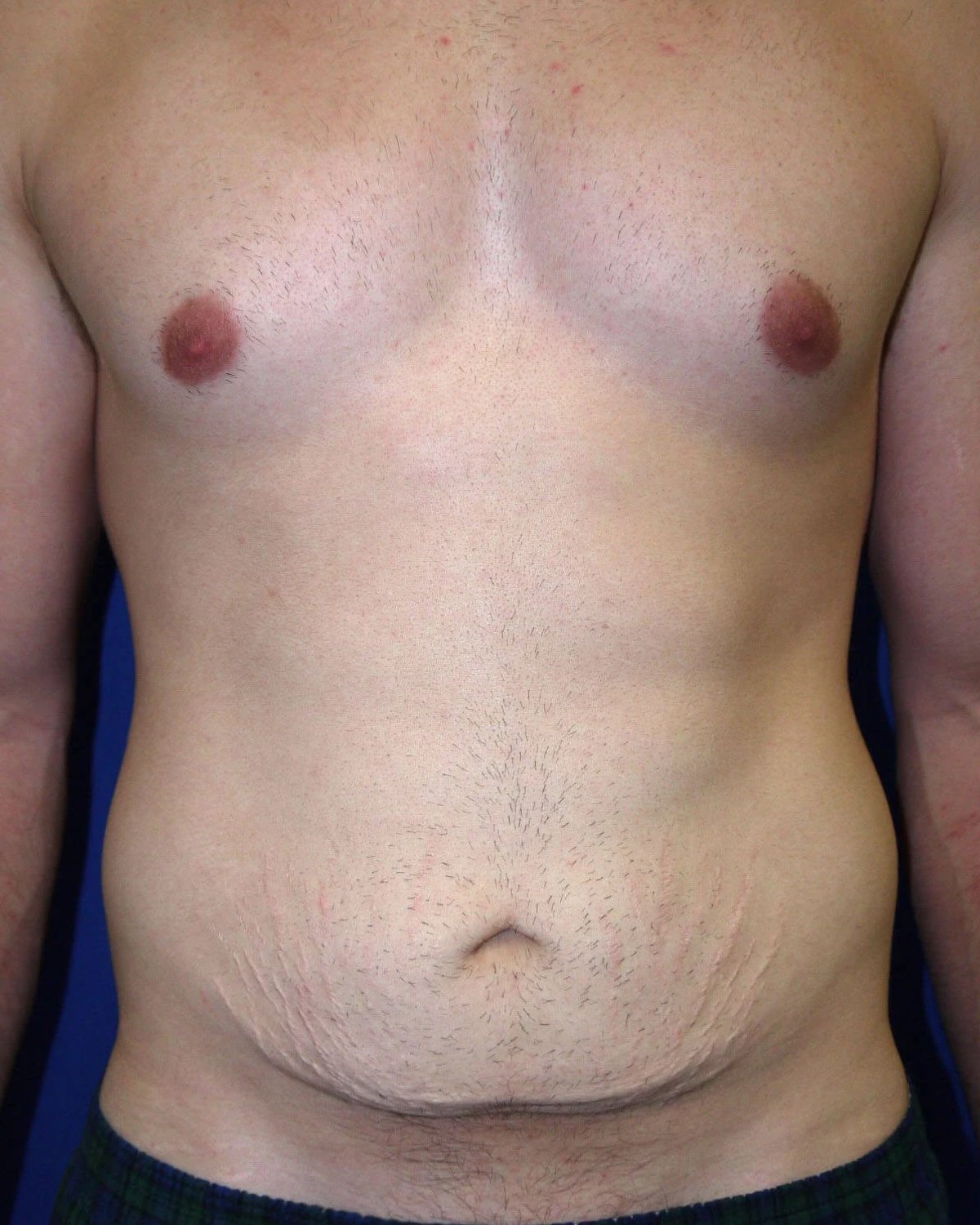 Tummy Tuck before