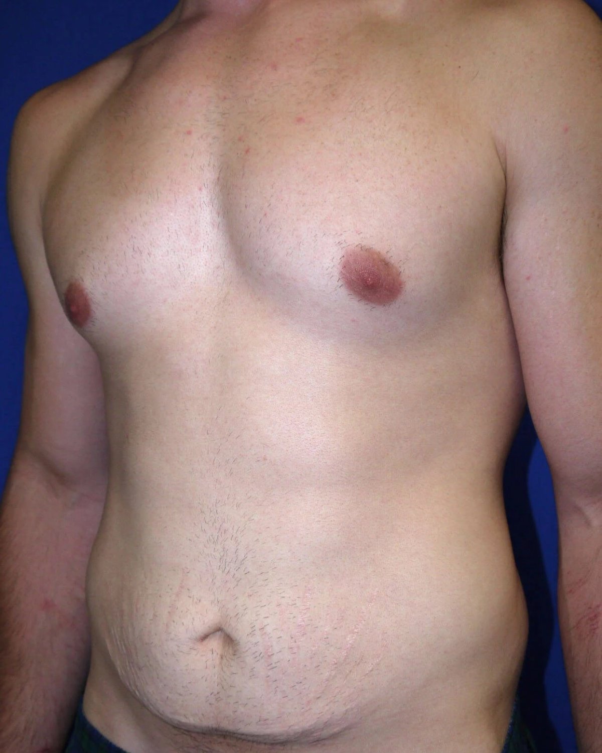 Tummy Tuck — Oblique Right view, before