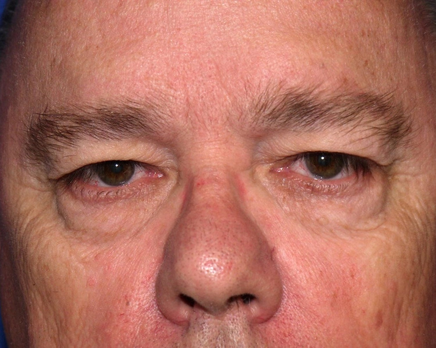 Facelift (neck lift included) before