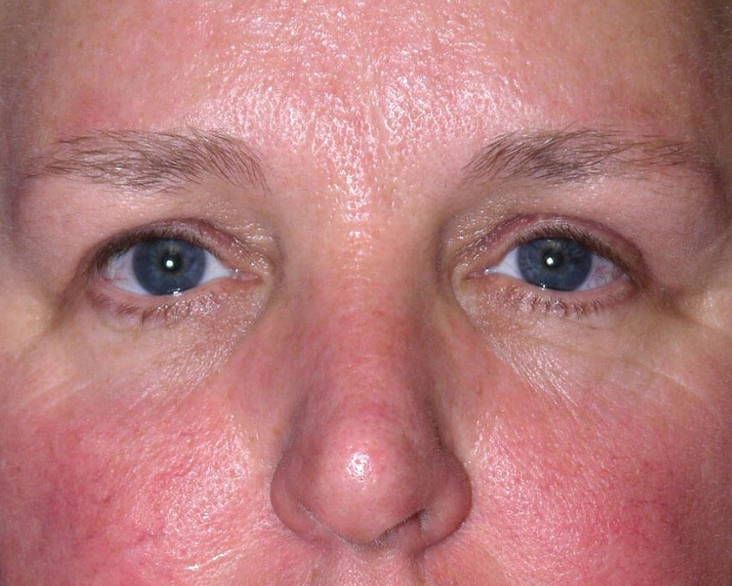 Facelift (neck lift included) after