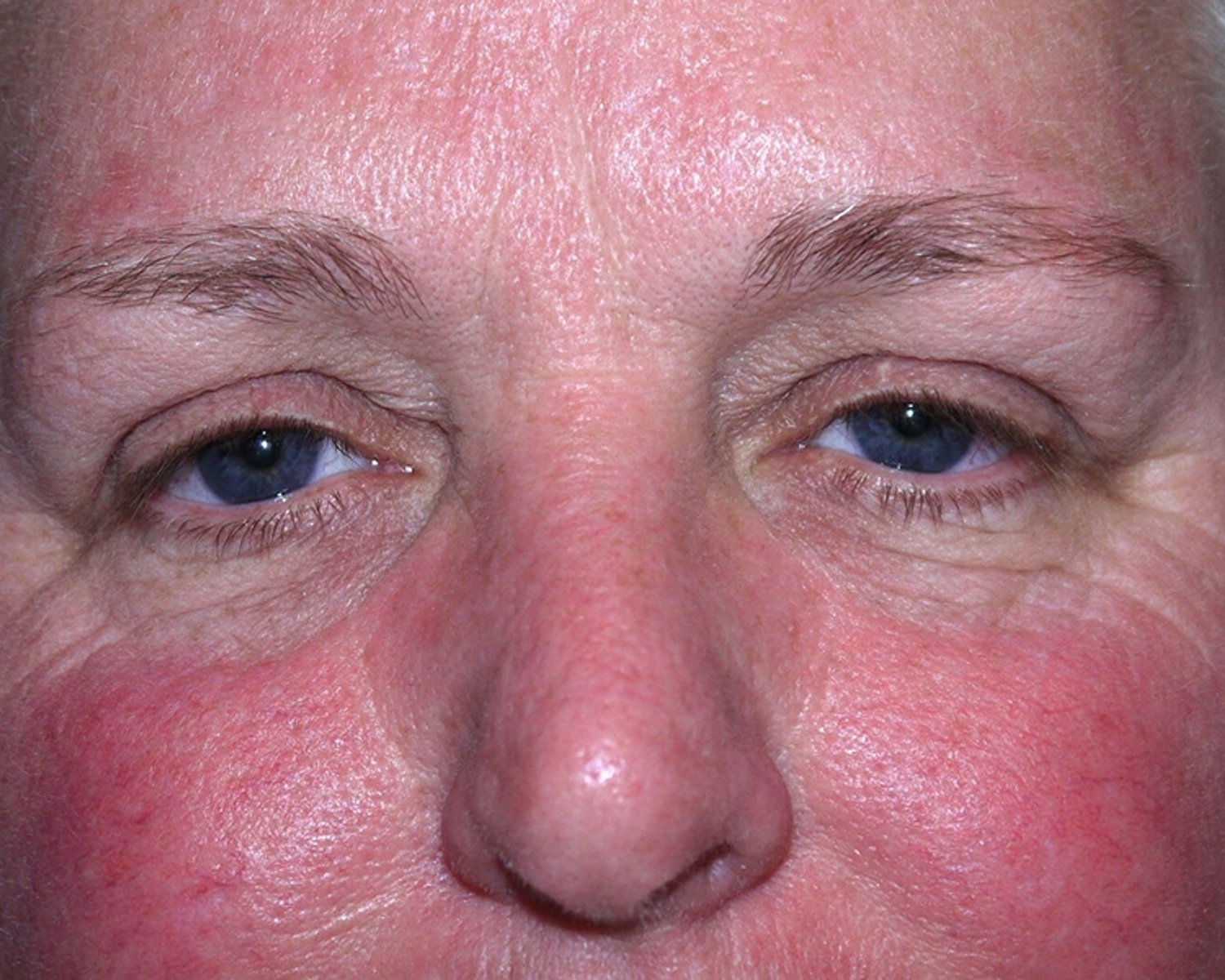 Facelift (neck lift included) before
