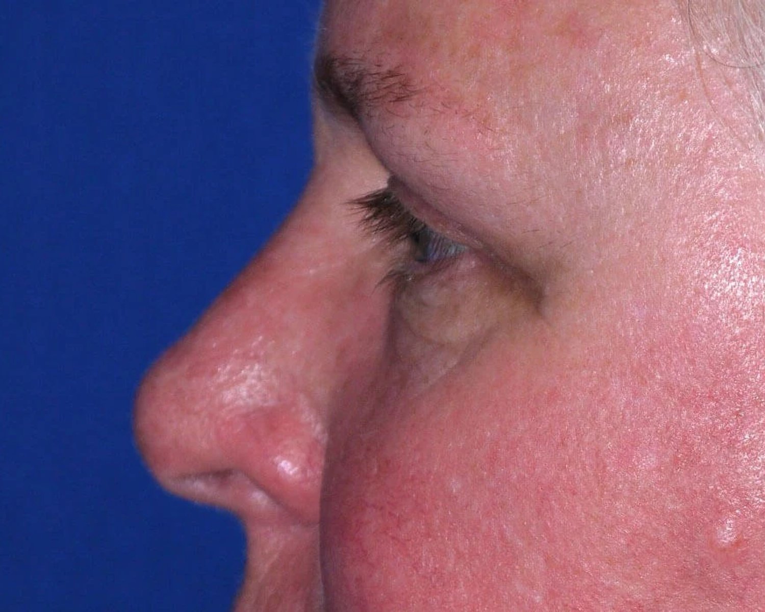 Facelift (neck lift included) — Left Profile view, after