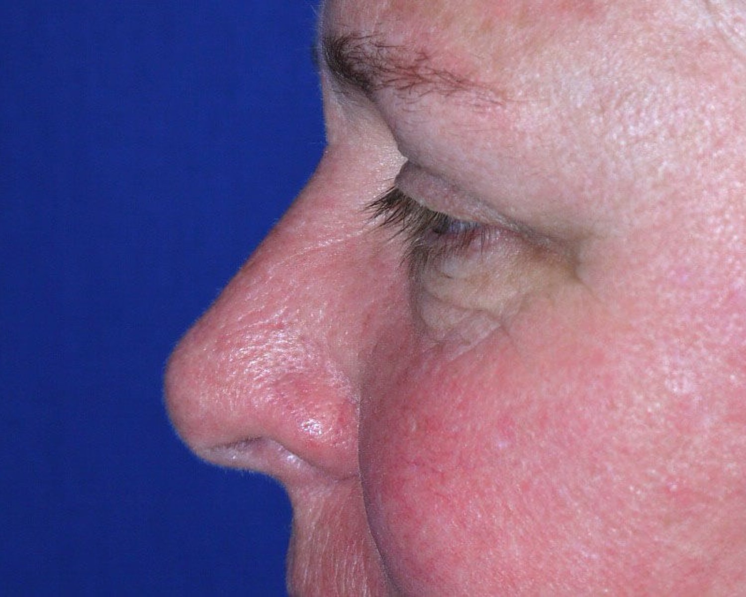 Facelift (neck lift included) — Left Profile view, before