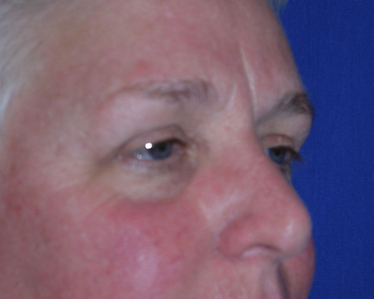 Facelift (neck lift included) — Oblique Right view, before