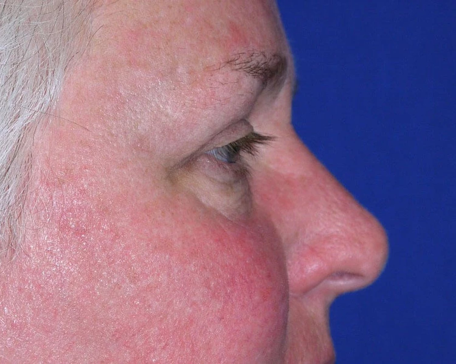 Facelift (neck lift included) — Right Profile view, after