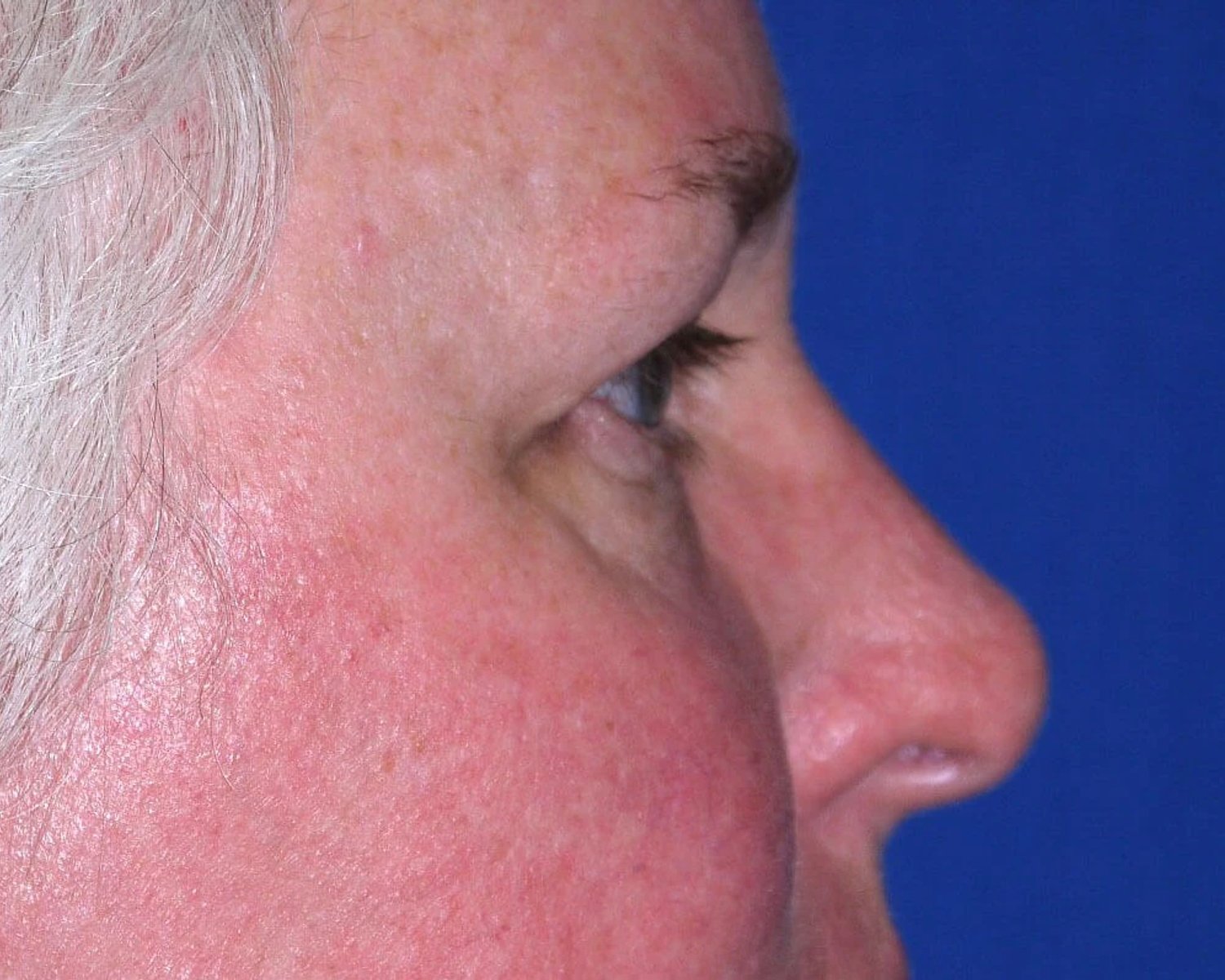 Facelift (neck lift included) — Right Profile view, before