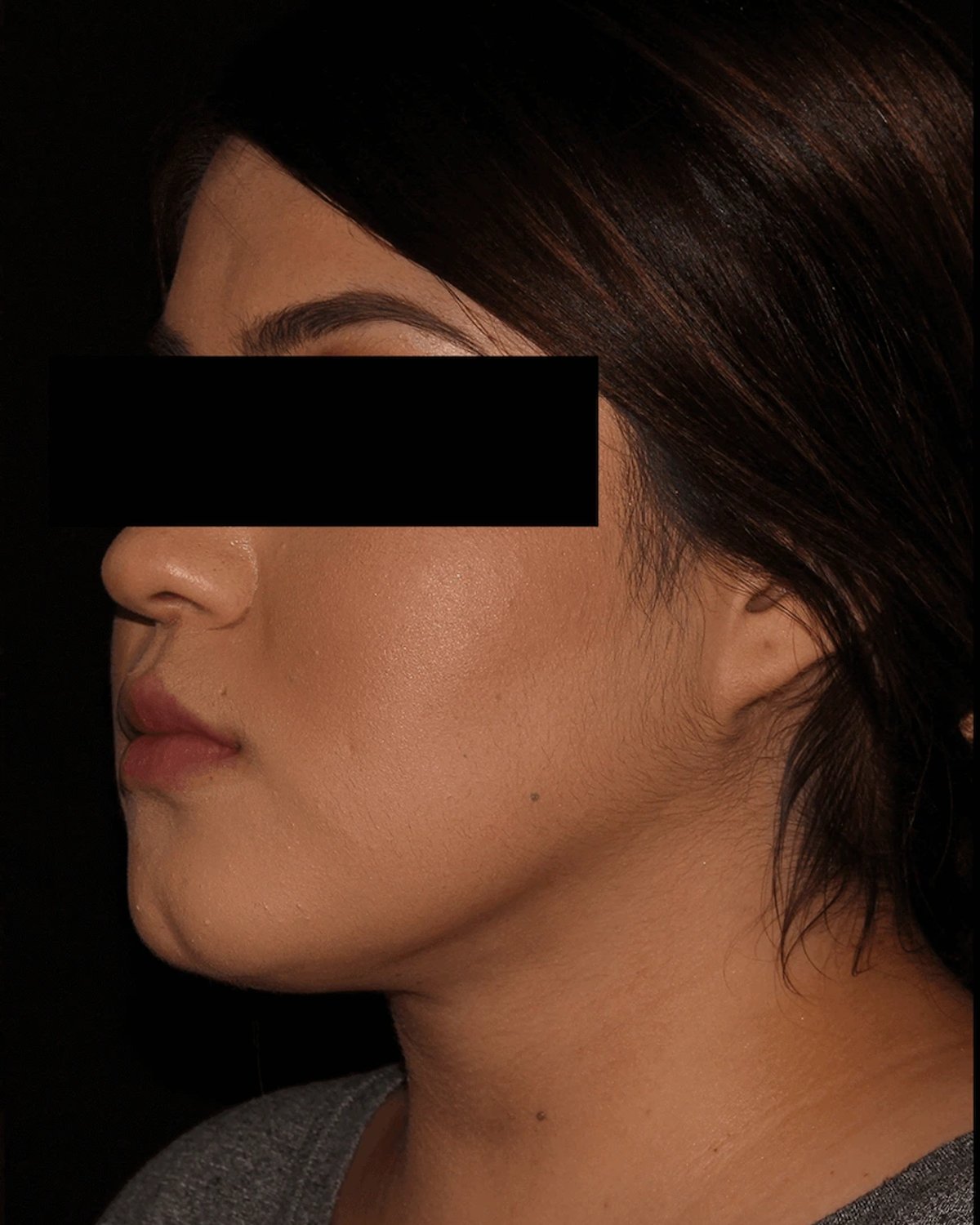 Front Liposuction (5L) (Same As Lipo360) after