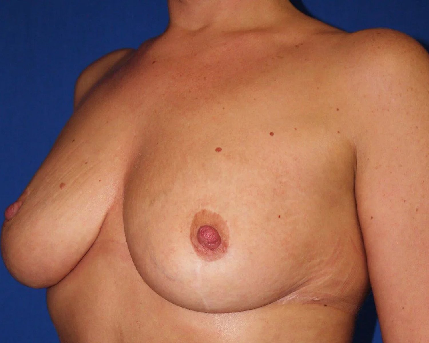 Breast Reduction — Oblique Left view, after