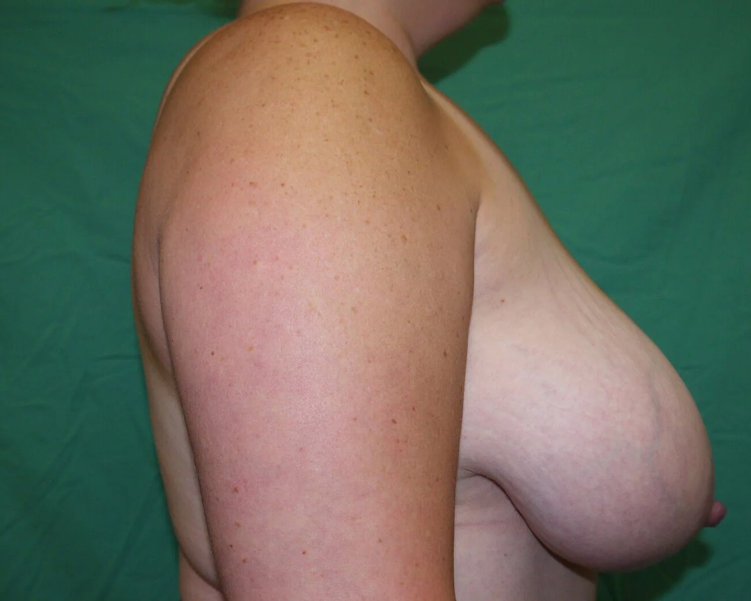 Breast Reduction — Oblique Right view, before