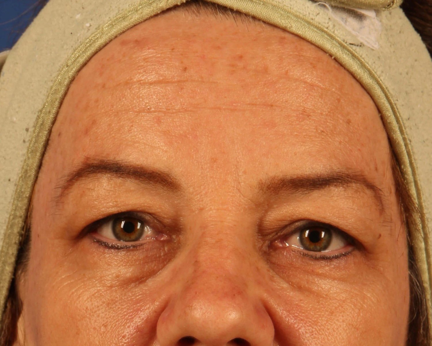 Eyelid Surgery before