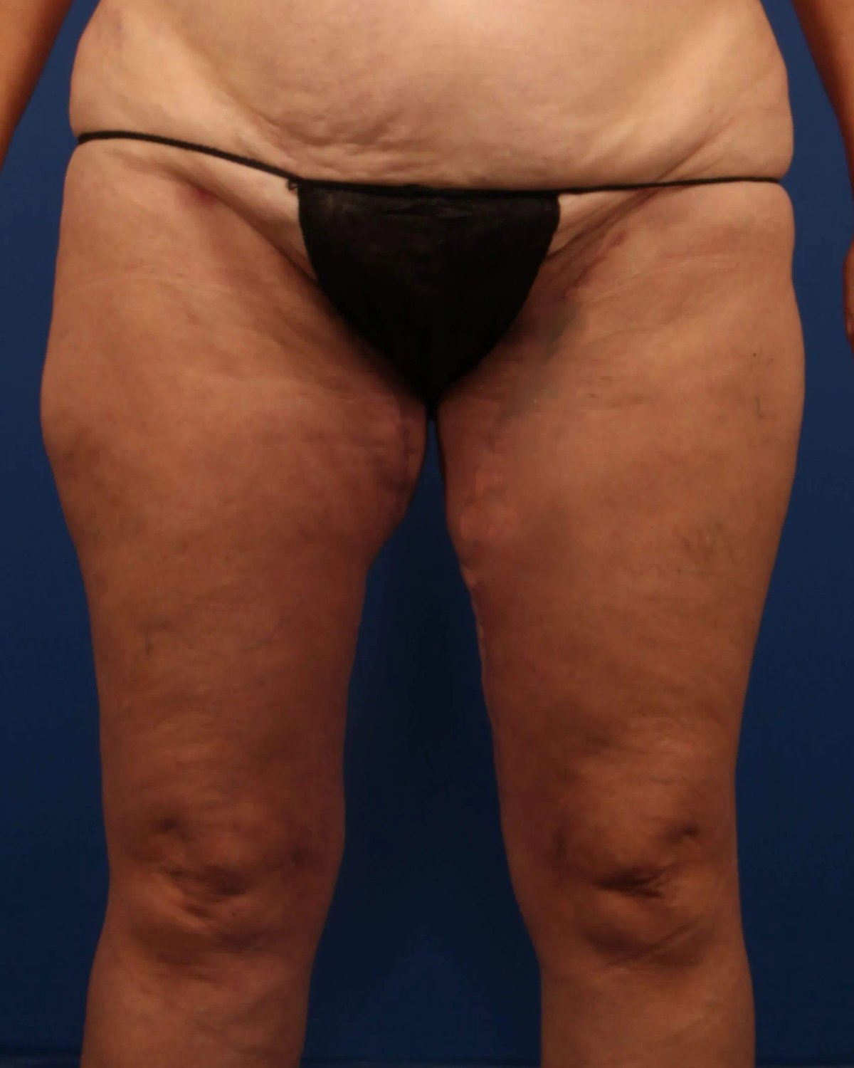 Thigh Lift (Medial) after