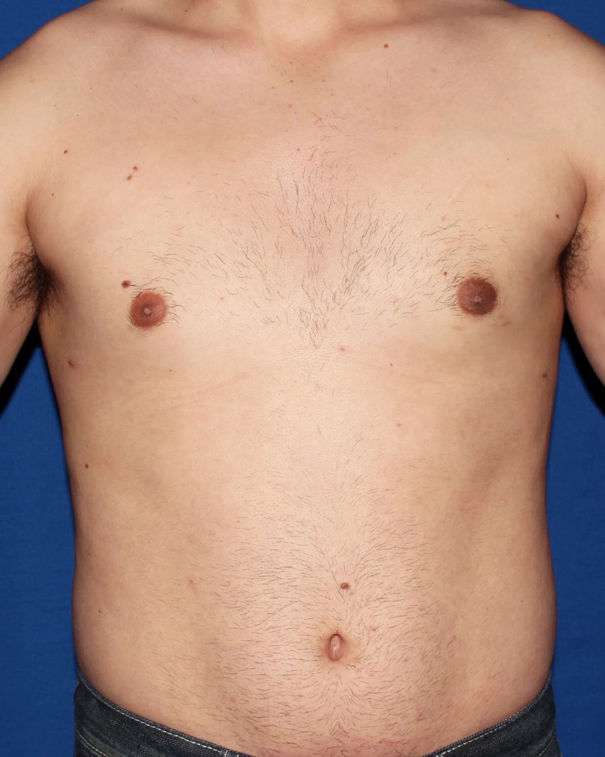 One-Stitch Gynecomastia after