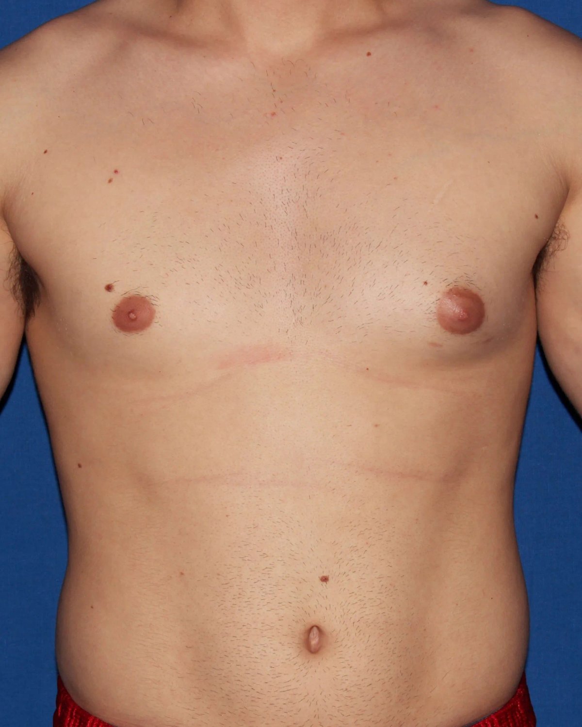 One-Stitch Gynecomastia before