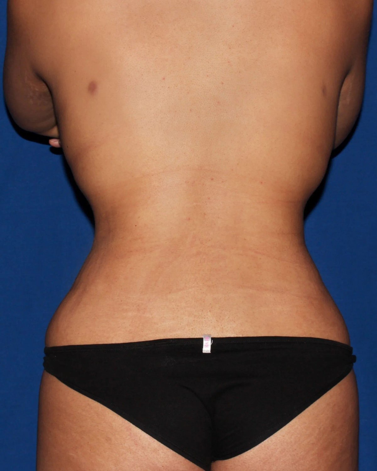 Front Liposuction (5L) (Same As Lipo360) — Back view, after