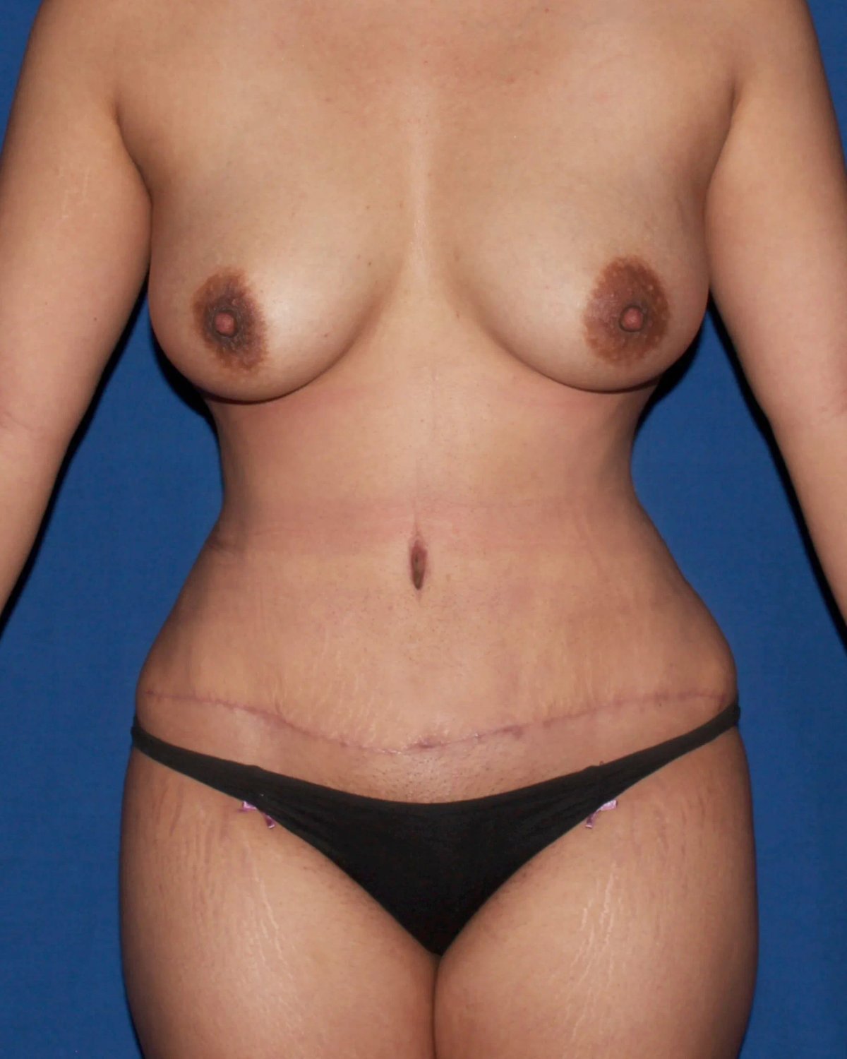 Front Liposuction (5L) (Same As Lipo360) after