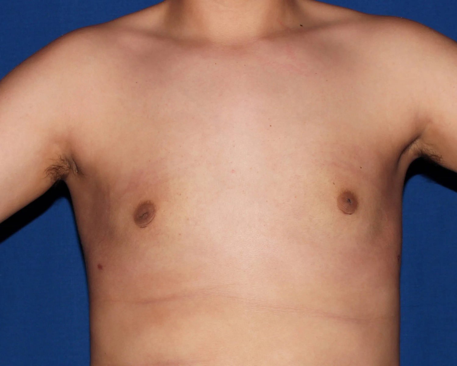 One-Stitch Gynecomastia after