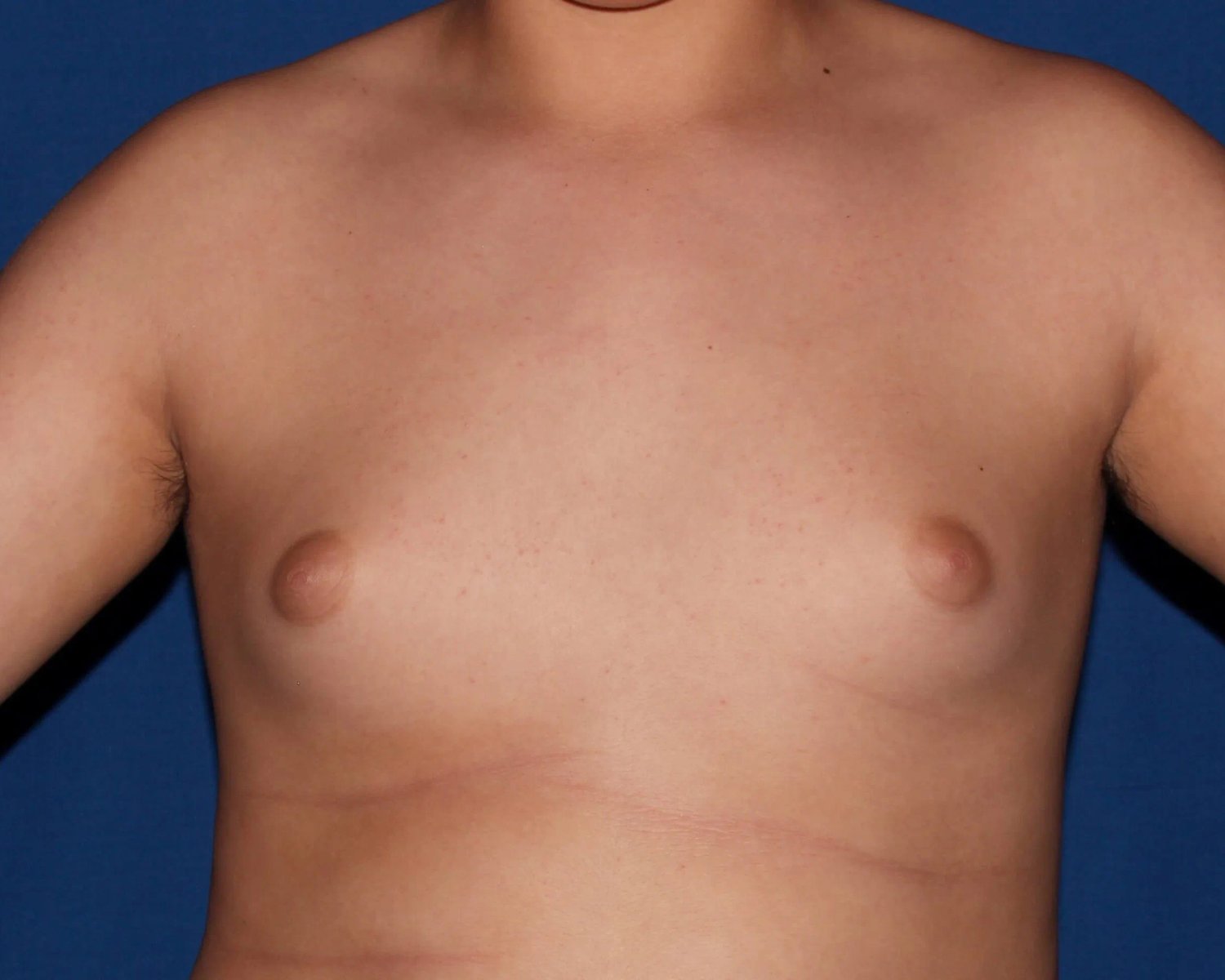 One-Stitch Gynecomastia before