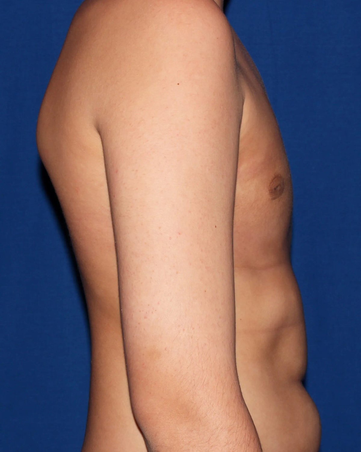 One-Stitch Gynecomastia — Right Profile view, after