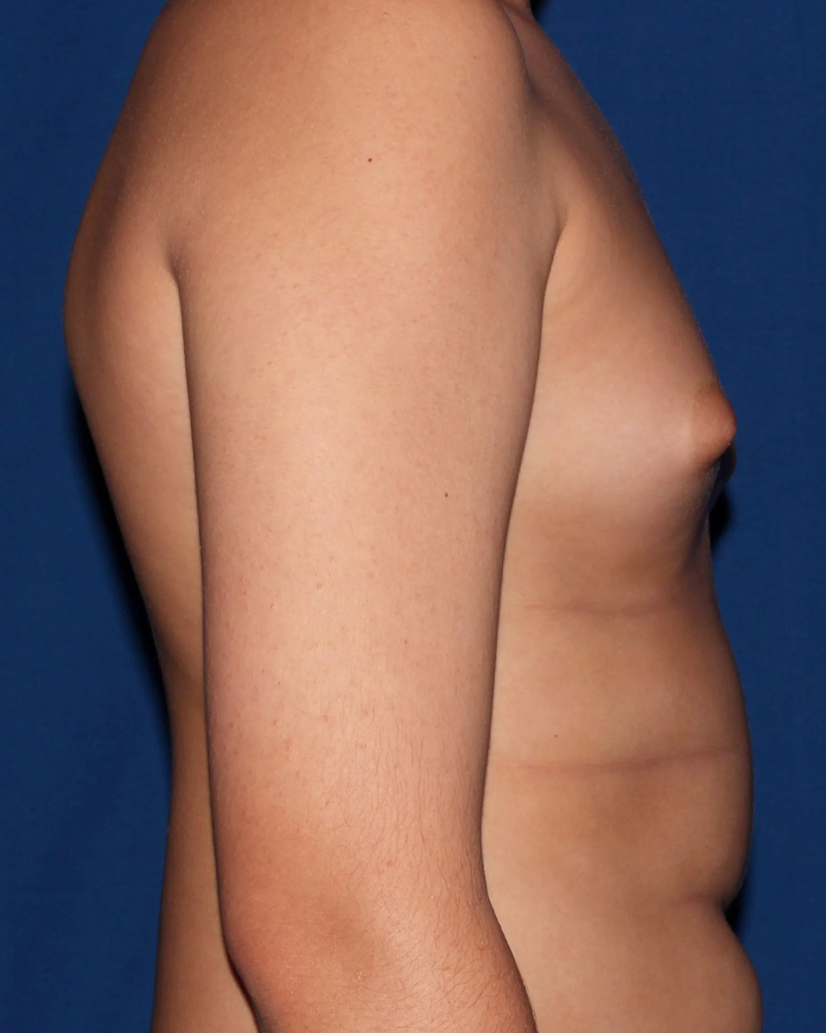 One-Stitch Gynecomastia — Right Profile view, before