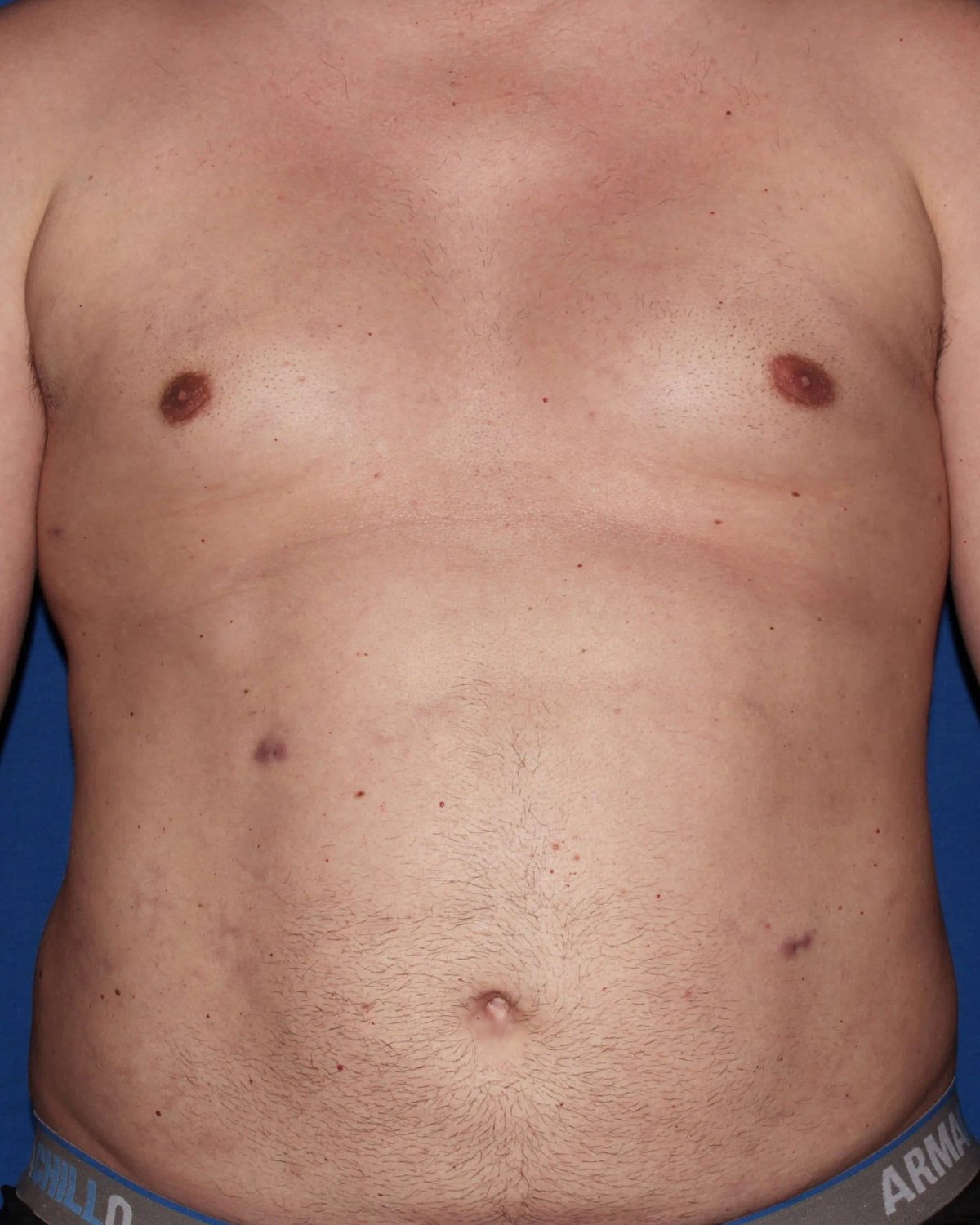 One-Stitch Gynecomastia after