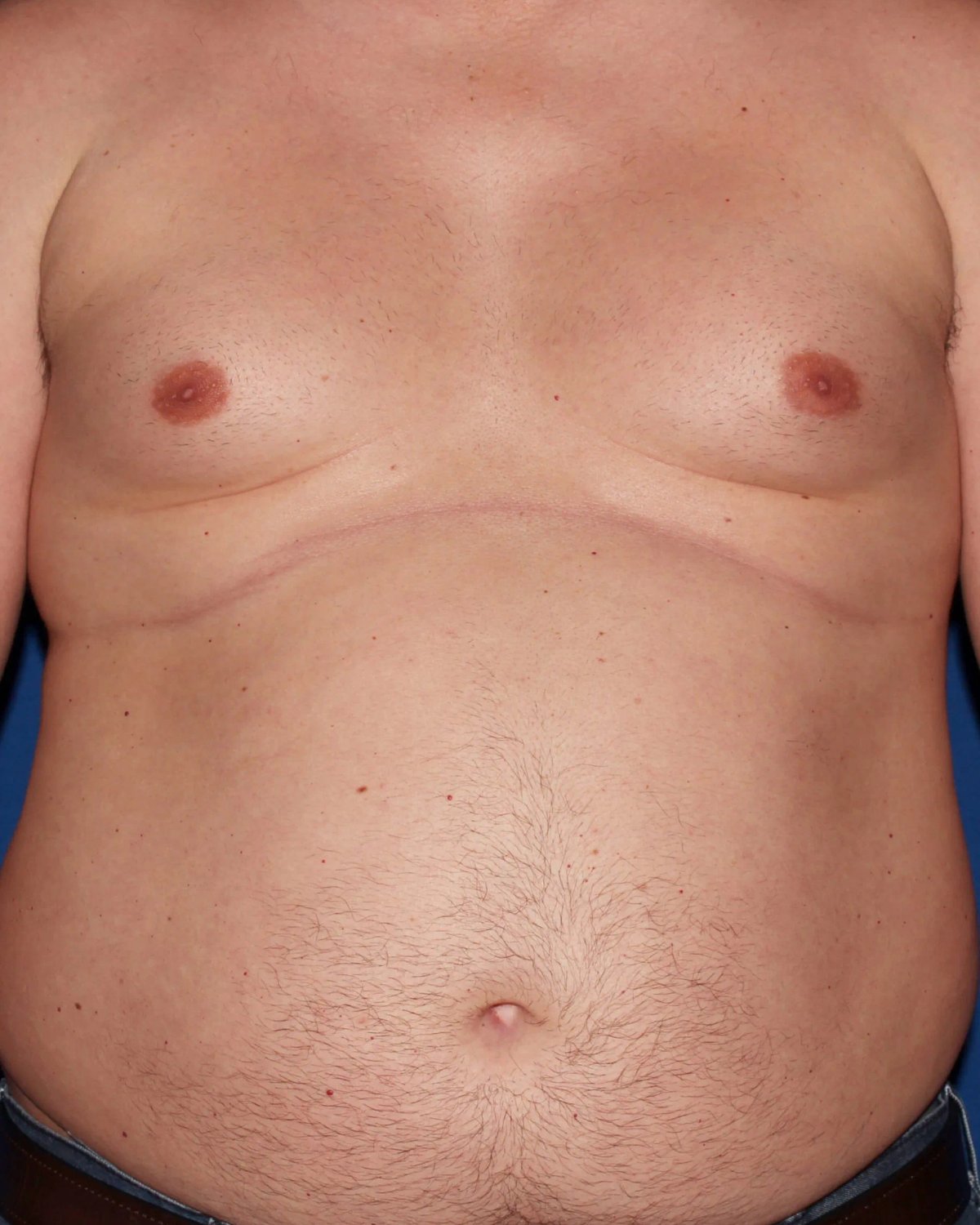 One-Stitch Gynecomastia before