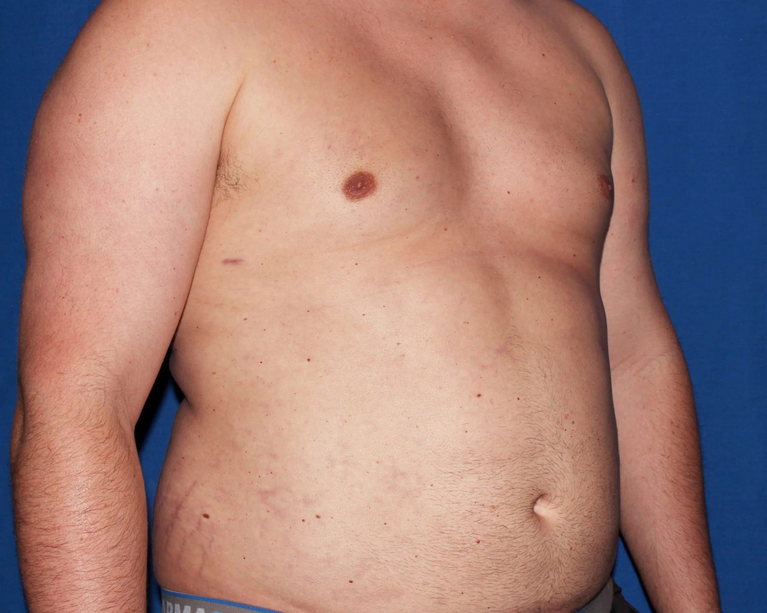 One-Stitch Gynecomastia — Oblique Right view, after
