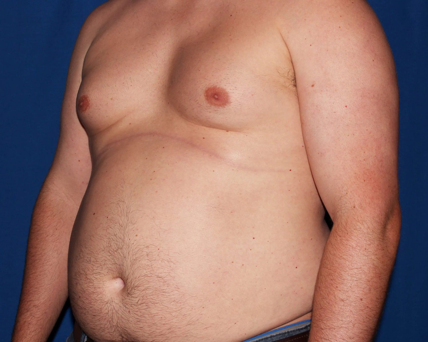 One-Stitch Gynecomastia — Oblique Right view, before