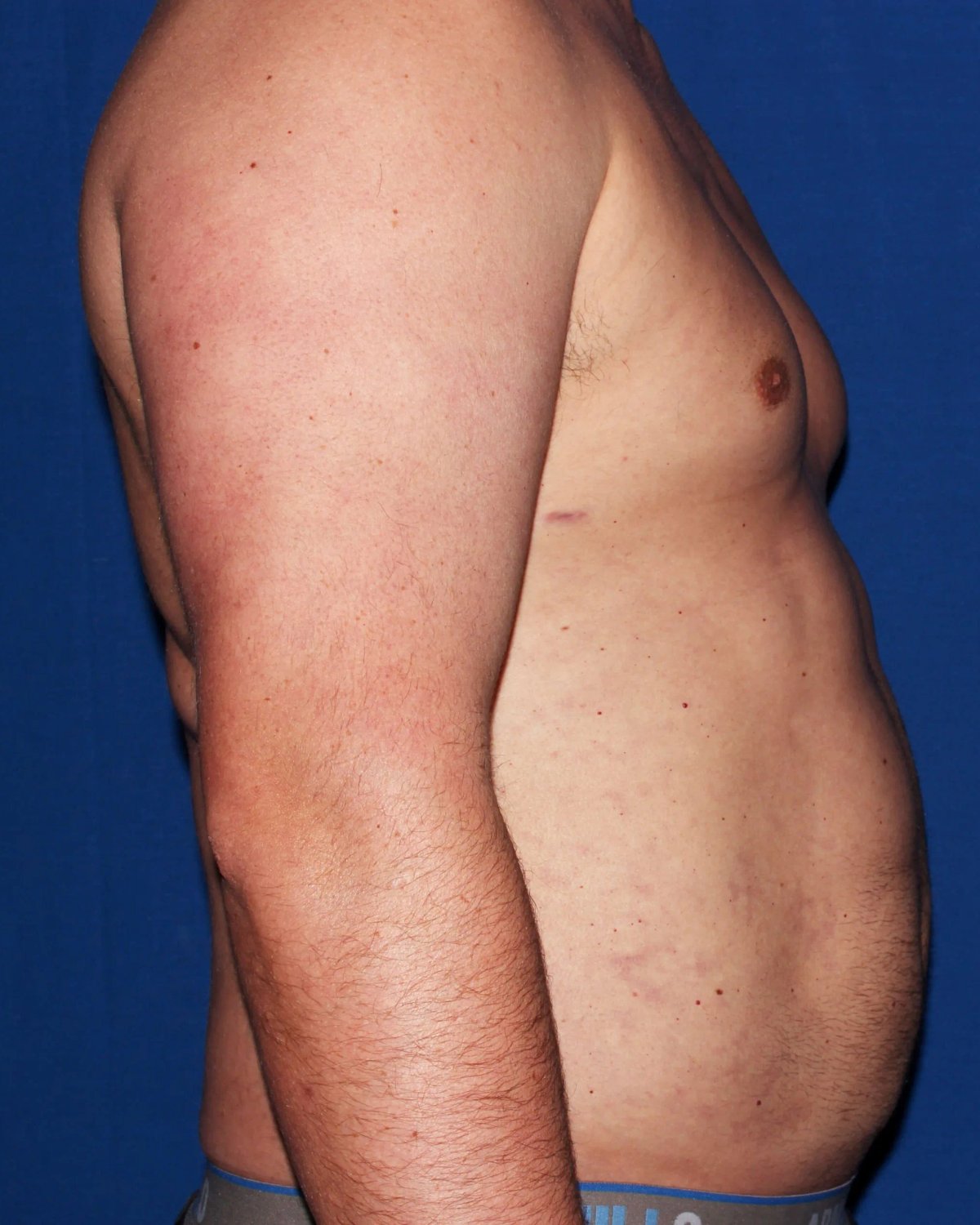 One-Stitch Gynecomastia — Right Profile view, after