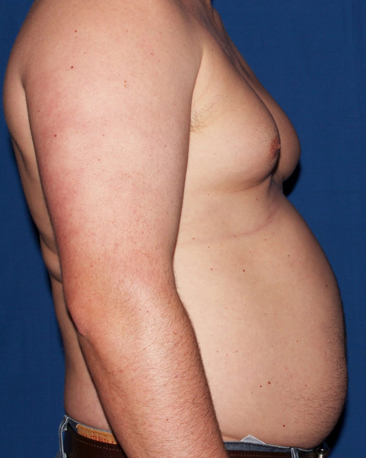 One-Stitch Gynecomastia — Right Profile view, before