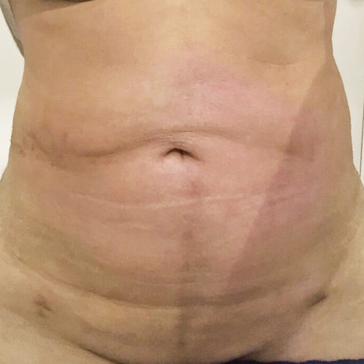 Front Liposuction (5L) (Same As Lipo360) after