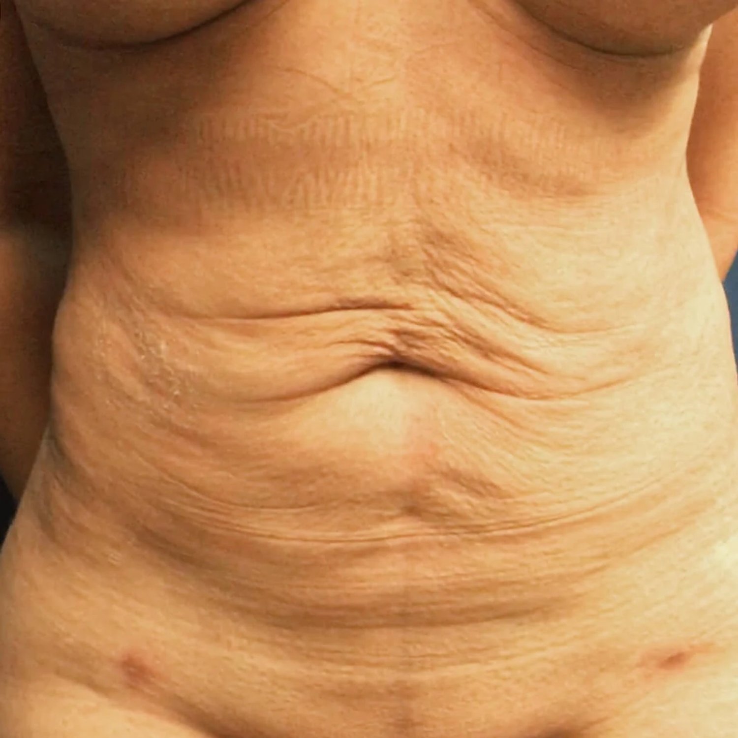 Front Liposuction (5L) (Same As Lipo360) before