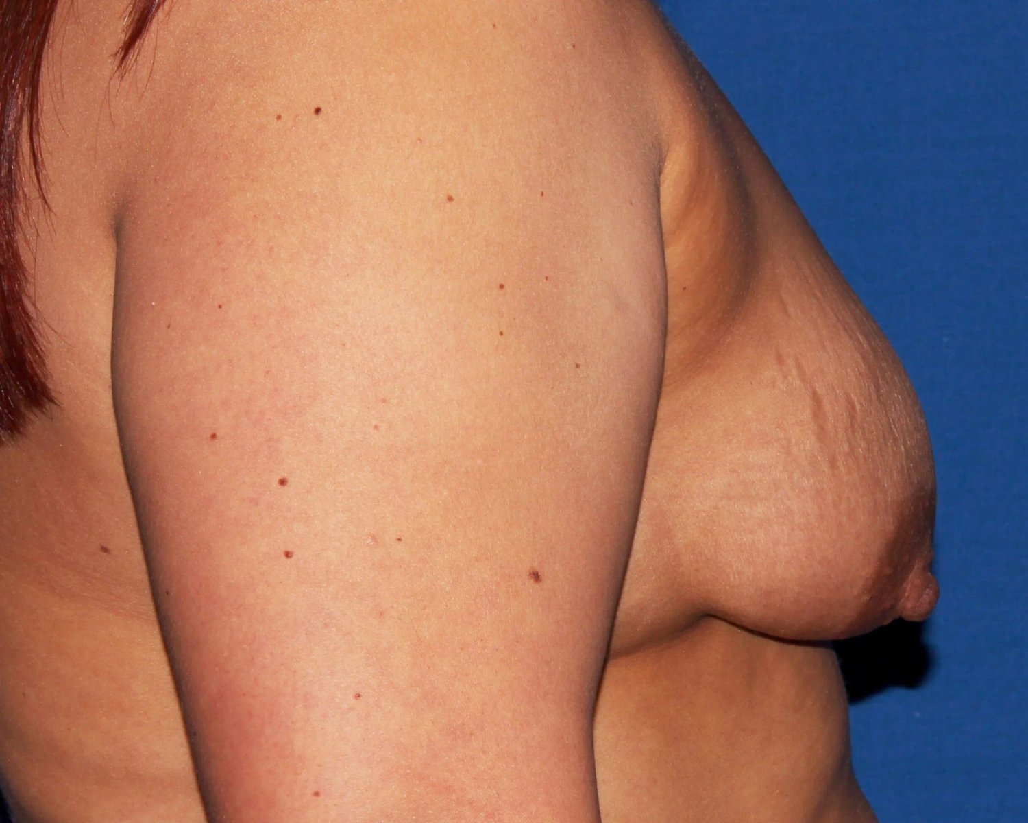 Breast Augmentation with Implants — Right Profile view, before