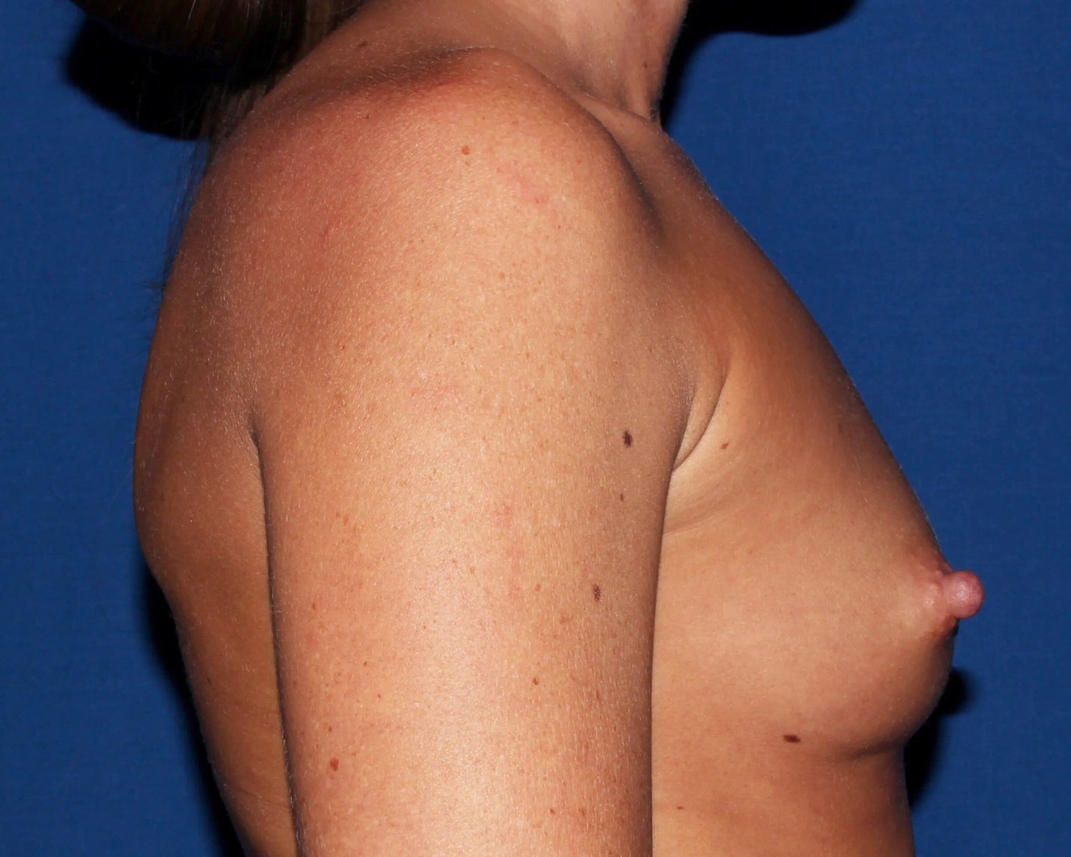 Breast Augmentation with Implants — Right Profile view, before