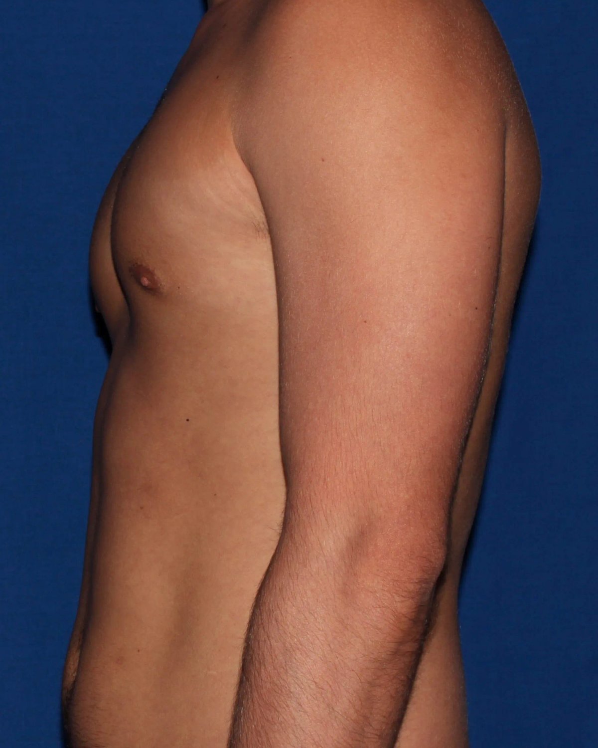One-Stitch Gynecomastia — Oblique Left view, after
