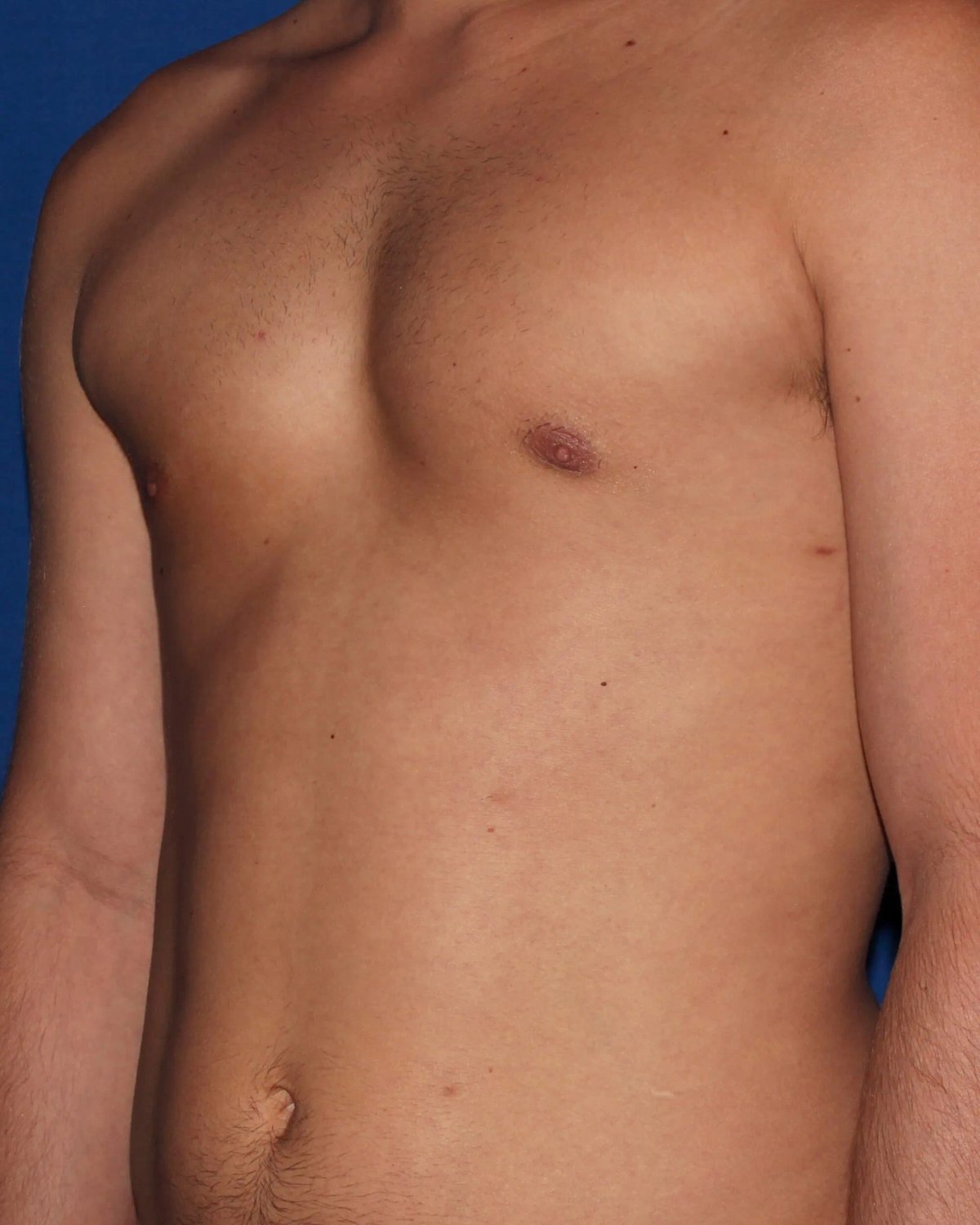 One-Stitch Gynecomastia — Oblique Right view, after