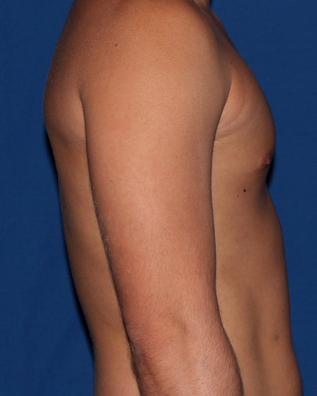 One-Stitch Gynecomastia after