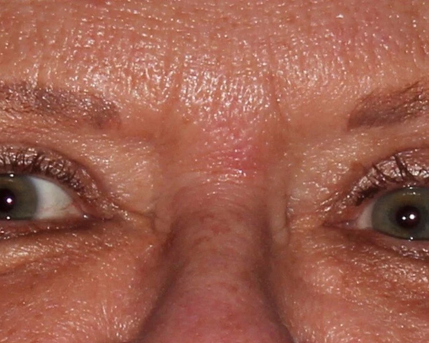 Eyelid Surgery after