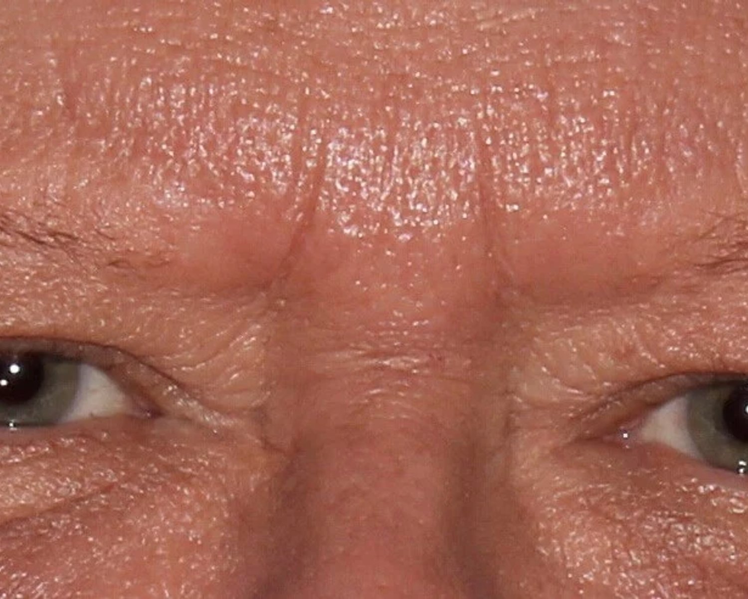 Eyelid Surgery before