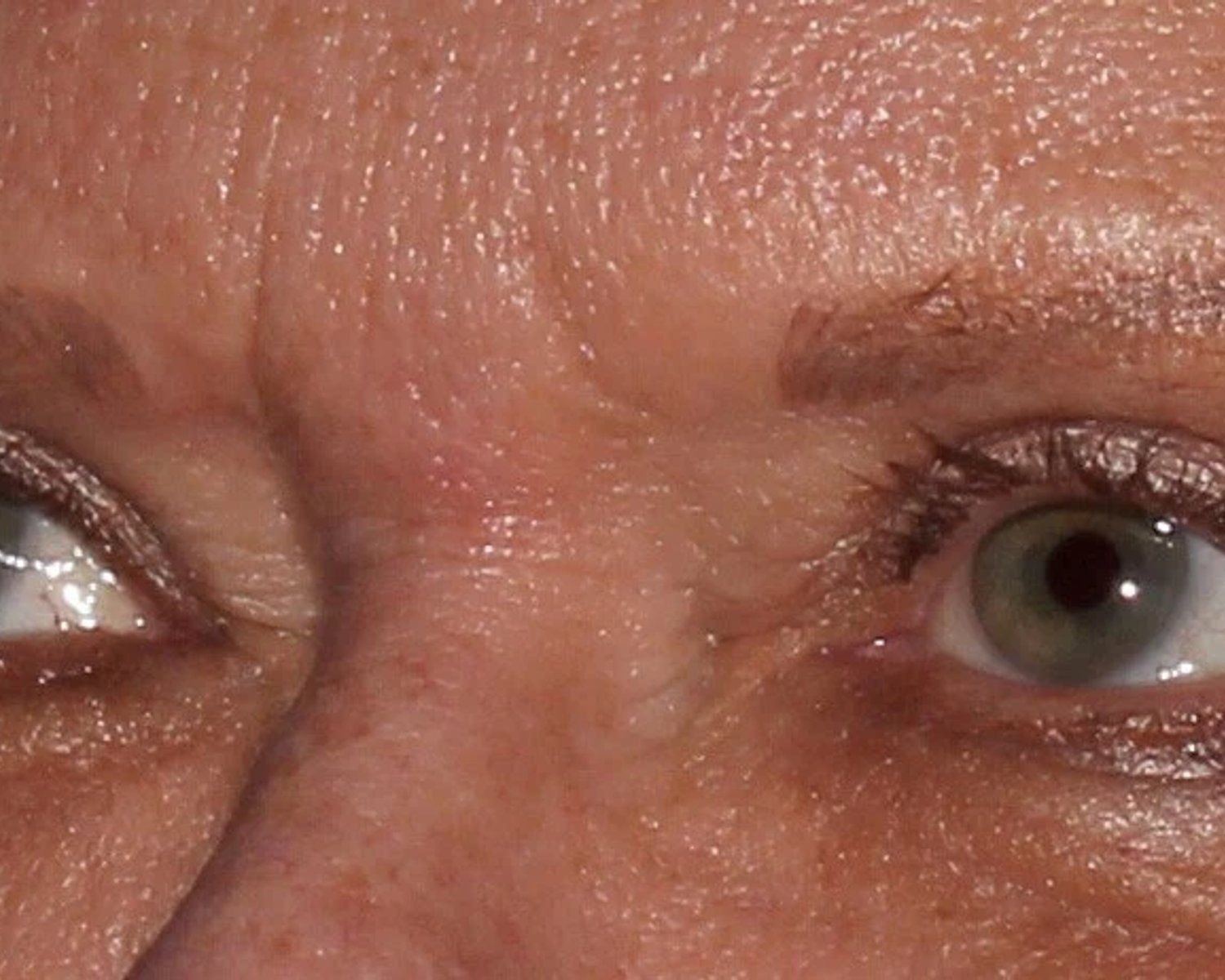 Eyelid Surgery — Oblique Right view, after