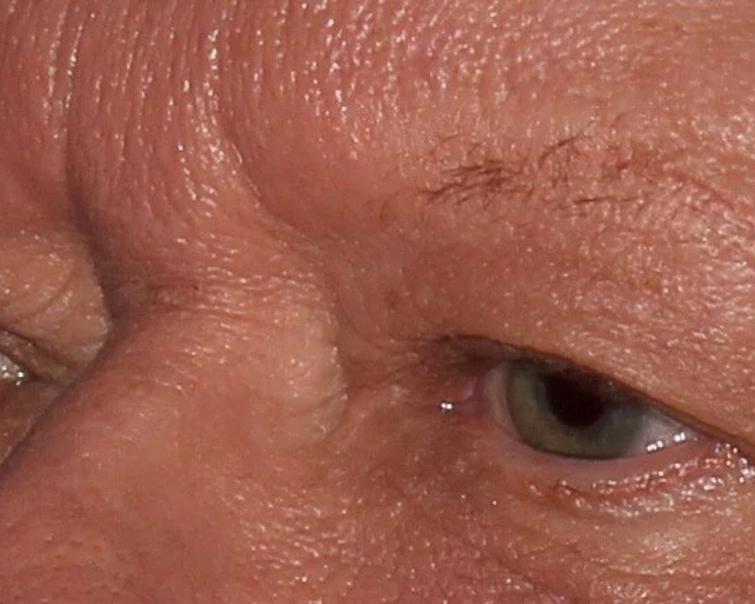 Eyelid Surgery — Oblique Right view, before